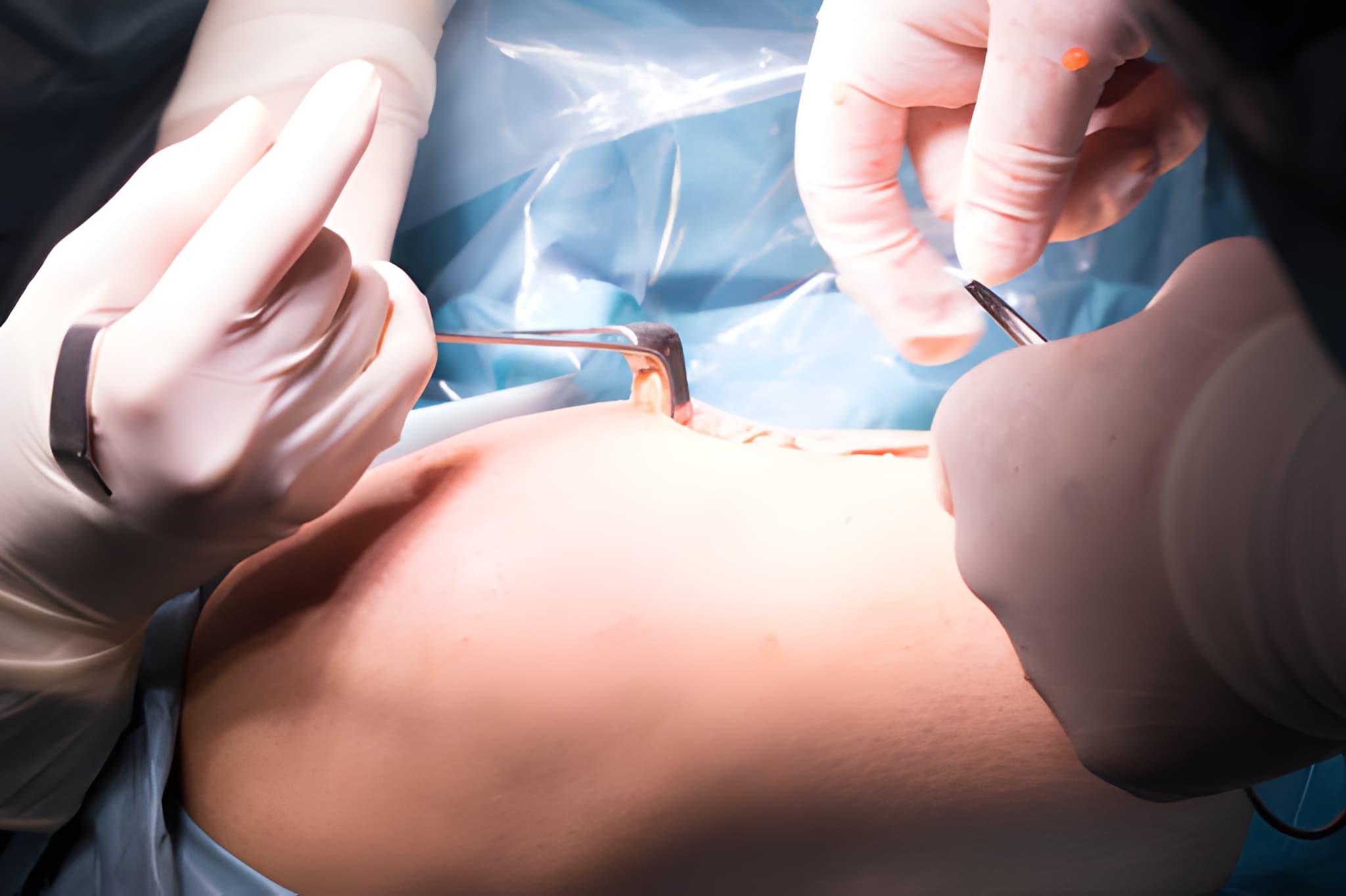 Laparoscopy vs Open Surgery